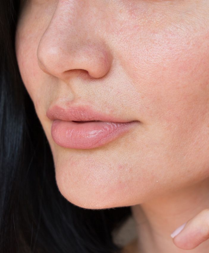 Fillers at AME Med Spa